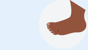 Les verrues plantaires, c'est pas le pied!